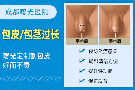 成都男性割包皮多少钱